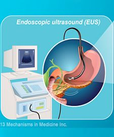 endoscopic-ultra-sound